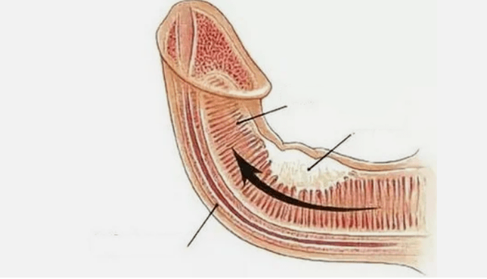 Élimination du drainage veineux